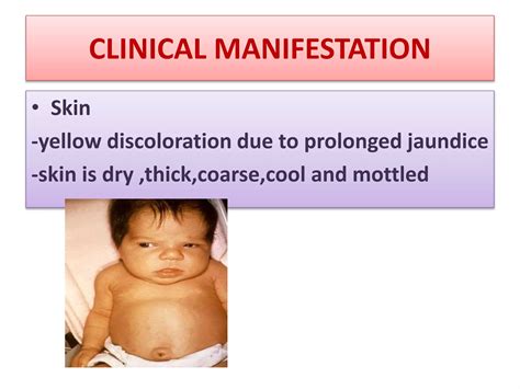 Hypothyroidism in children | PPTX