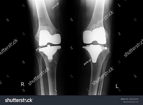 Total Knee Replacement Both Knee Stock Photo 2266005059 | Shutterstock