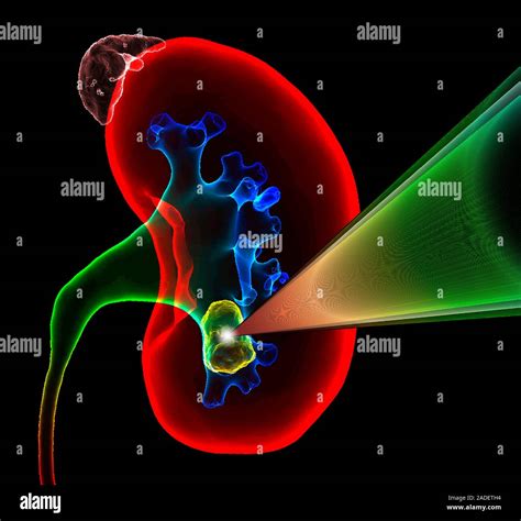 Kidney stone shock wave treatment. Illustration of extracorporeal shock ...