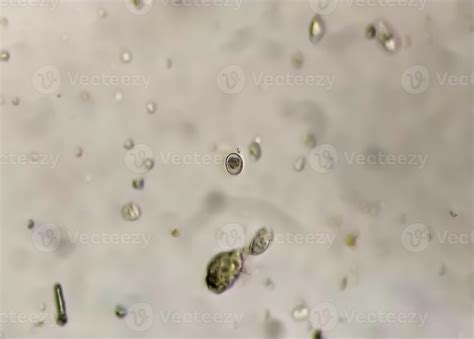 Schistosoma Parasite ova in human urine specimen under microscope ...