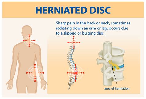 Bulging Disc vs Herniated Disc: Key Differences & Symptoms