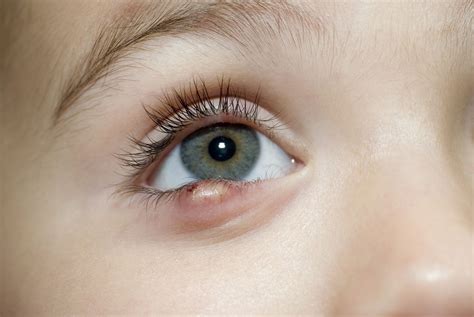 Lumps & Bumps On Eyelid | Olelo