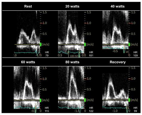 Echocardiogram Of Heart Failure