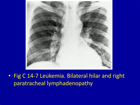 14 hilar and mediastinal lymph node enlargement | PPTX