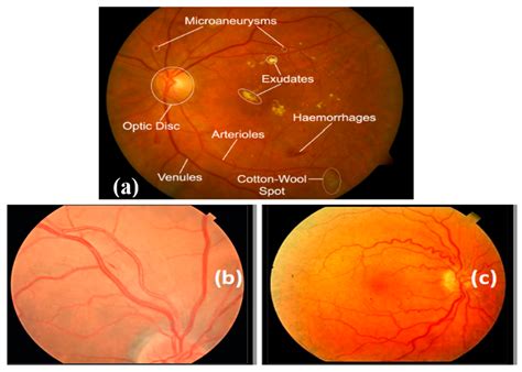 What Is Av Nicking at Carlos Mcclellan blog
