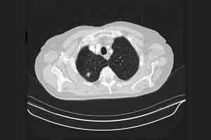 Incidental Pulmonary Nodules Detected on CT Images