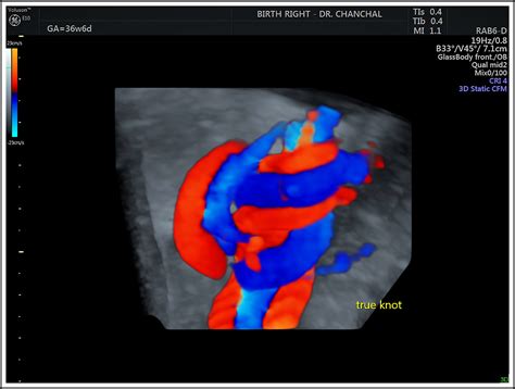 Prenatal Diagnosis of True Knot of the Umbilical Cord - Journal of ...