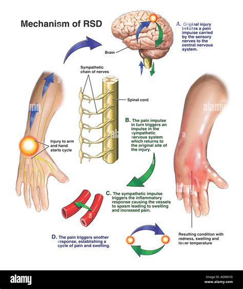 Reflex Sympathetic Dystrophy Rsd