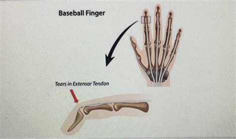 Mallet Baseball Finger