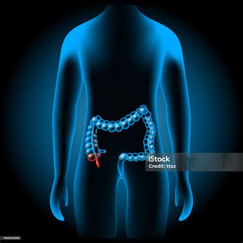 Image result for Appendix Inflammation