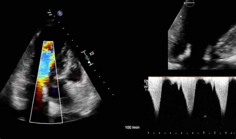 Stellenwert der kardialen Bildgebung bei Kardiomyopathien - Kardiologie ...