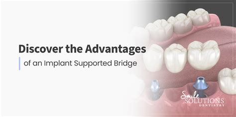 Discover the Advantages of an Implant-Supported Bridge