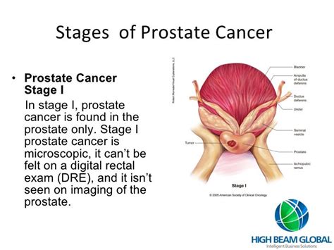 Resultado de imagen de prostate+cancer+stages