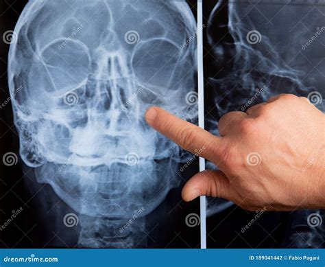 Nasal Bone Anatomy X Ray