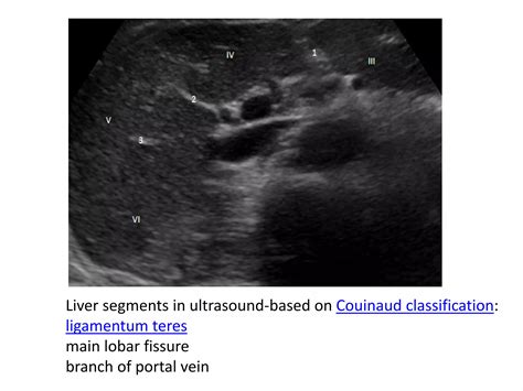 LIVER SEGMENTAL ANATOMY AND IMAGINGIN IN LIVER CIRRHOSIS.pptx