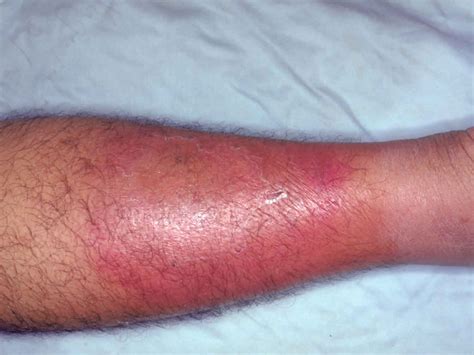 Cellulitis Symptoms
