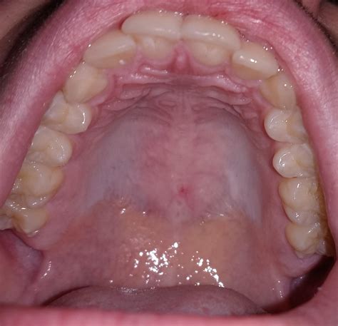 Black And White Spots On Roof Of Mouth at Marianne Holt blog