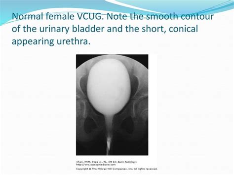 Image result for Retrograde Urethrogram RadioGraphics