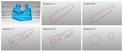 CBCT-Based Design of Patient-Specific 3D Bone Grafts for Periodontal ...
