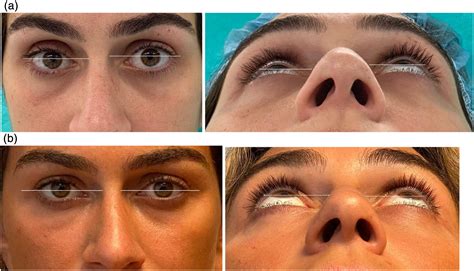 Silent Sinus Syndrome: A Case of Orbital Reconstruction With Patient-specific Implant and ...