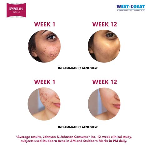 Benzol-10% Face Wash | Uses, Side Effects, Price | Apollo Pharmacy