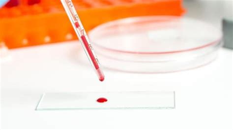 New DNA-based blood tests to detect unidentifiable skin cancers in 48 ...