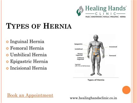 Lumbar Hernia In English at Rodney Hickman blog