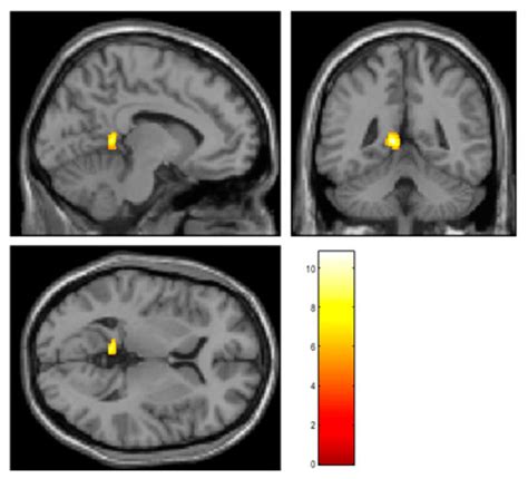 Atrial Fibrillation: State-of-the-Art Techniques and Future ...