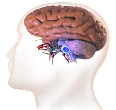 Acoustic Neuroma: Gamma Knife (Radiation) or Regular Surgery? » Scary Symptoms
