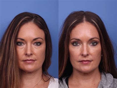 Eyelid Surgery for Scottsdale & Phoenix, AZ – Hobgood Facial Plastic Surgery