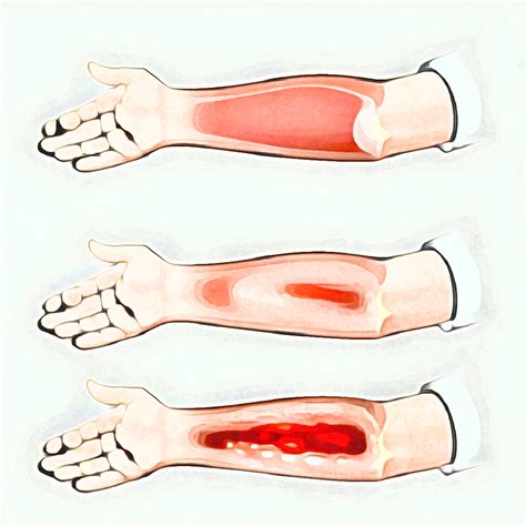 Primeros Auxilios Basicos Manual : Atender Quemaduras de Primer Grado
