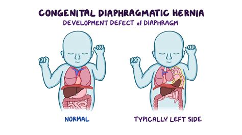 Congenital Diaphragmatic Hernia