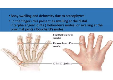 Degenerative condition of joints and spine For G.N.M 2nd & B.Sc.2nd ...