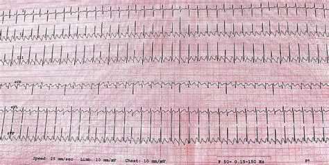 Image result for Atrial Flutter ECG Pattern
