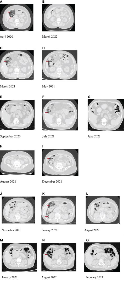 Frontiers | Pneumatosis cystoides intestinalis in dermatomyositis: a case series report and ...