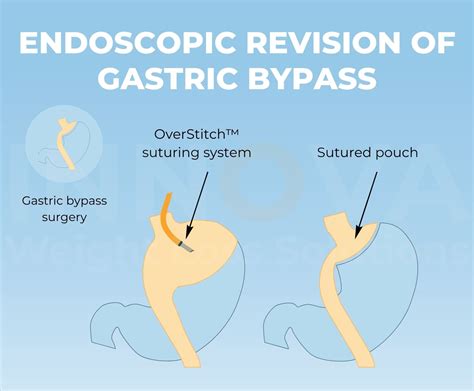 Gastric Bypass Revision – Innova Weight Loss Solutions