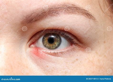 Inflammation, Redness in the Lower Eyelid. Chalazion Gordolum. Girl`s Eye Close Up. Stock Image ...