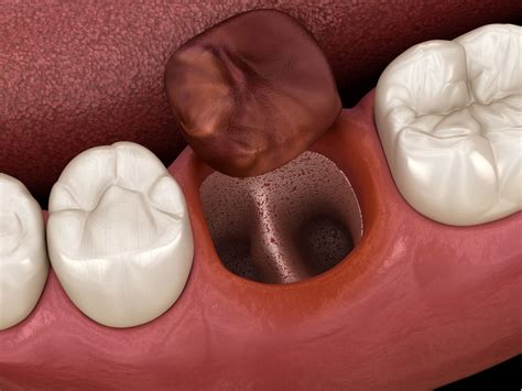 What to Know About Dry Sockets | 3D Dentistry in Bradenton, FL