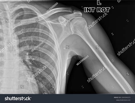Internal Rotation Shoulder Xray