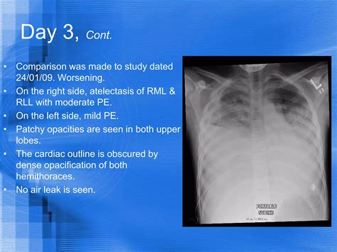 Acute Chest Syndrome of Sickle Cell Anemia | PDF