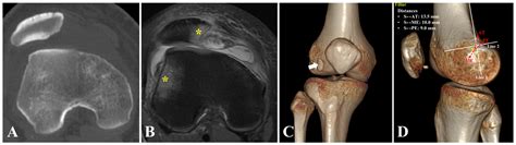 A Novel Technique of Arthroscopic Femoral Tunnel Placement during ...