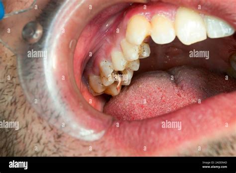 Image result for Pulp Extraction Tooth