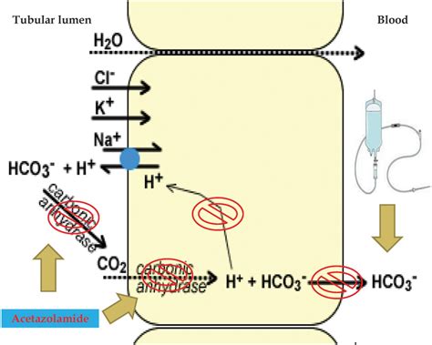Safety and effectiveness of the combination acetazolamide and ...