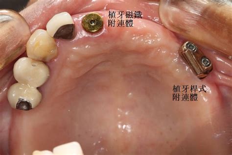 植牙支撐全口假牙_成功案例_品橙牙醫診所 | 高雄植牙,高雄齒顎矯正