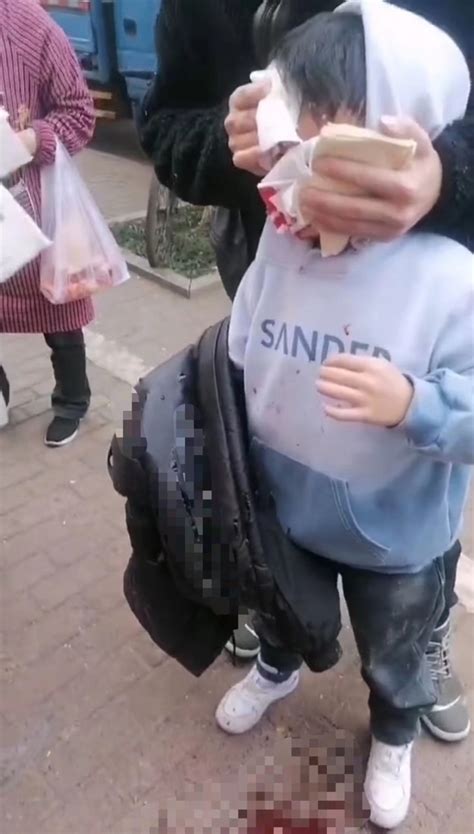 8岁男童买早餐遭狗扑咬脸部被缝90多针，江西吉安警方：正全力寻找狗主人_腾讯新闻