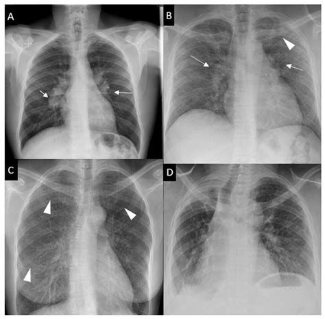 Sarcoidosis: A Clinical Overview from Symptoms to Diagnosis