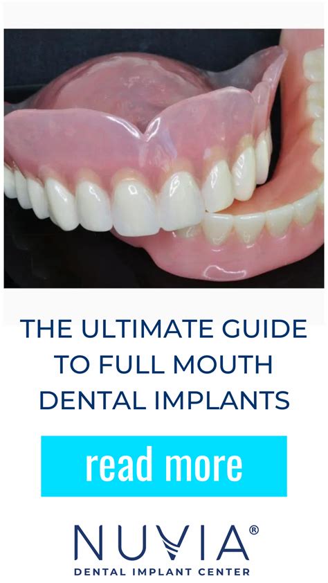 The Ultimate Guide To Full Mouth Dental Implants In 2022. Everything you need to know about ...