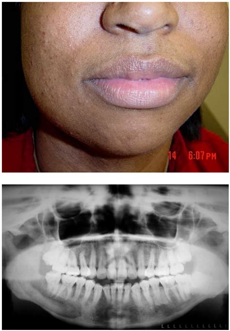 Bony Lesions | IntechOpen