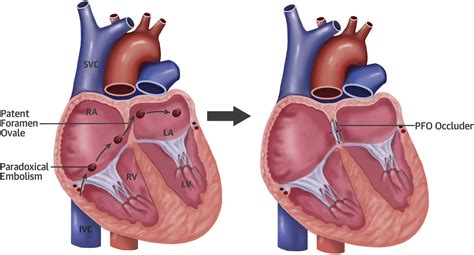 Device Closure of Patent Foramen Ovale in Patients With Cryptogenic Stroke: The Tide Has Turned∗ ...