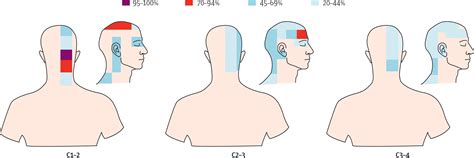 Cervicogenic headache: an assessment of the evidence on clinical ...